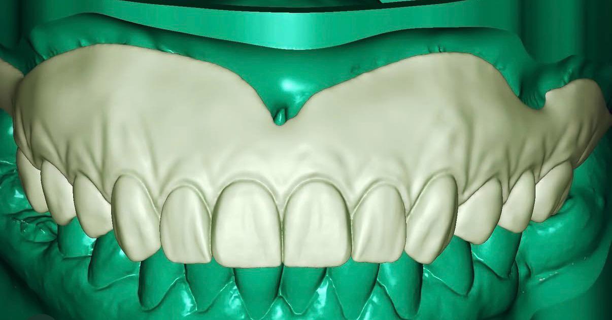 Implant restorative design