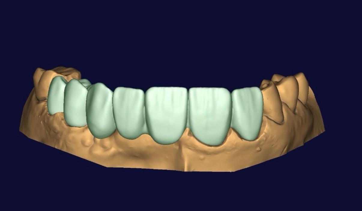 Restorative dental design